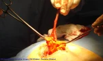 catheter-epiploon 2