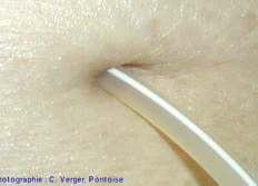 Catheters