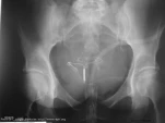 crosse-malposition2