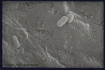 peritonitescan02